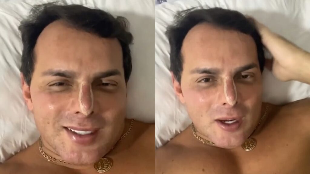 Esdras de Souza realizou mais uma harmonização facial no último sábado (03/09)